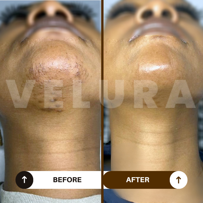 Velura® Rotundus Therapy