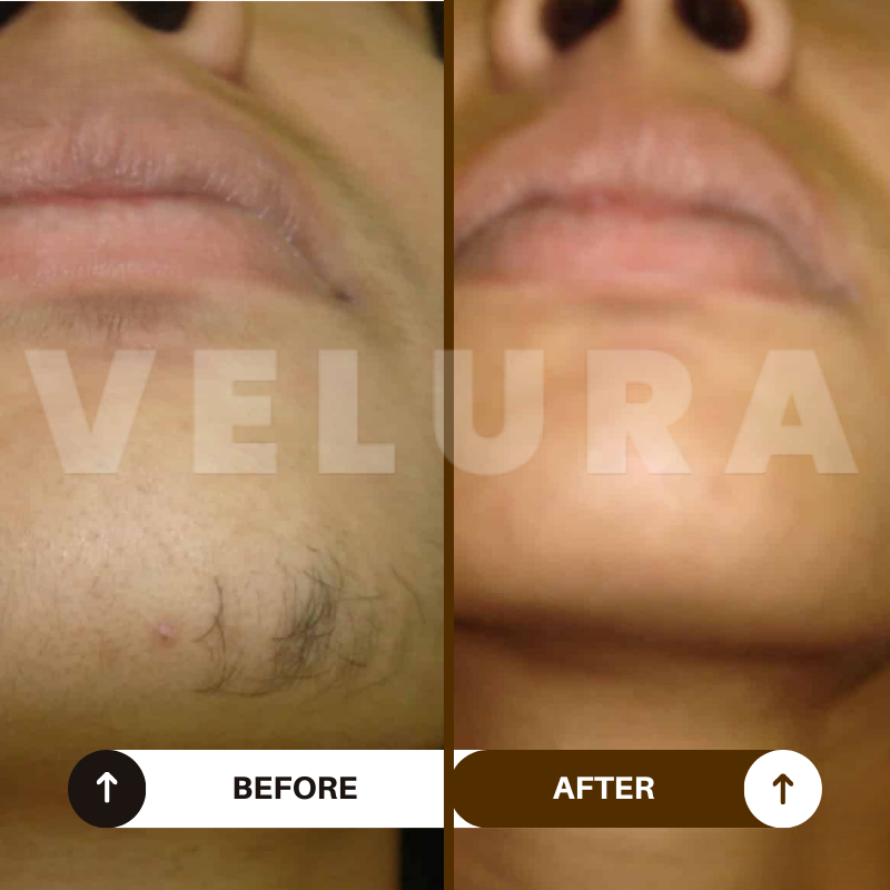 Velura® Rotundus Therapy