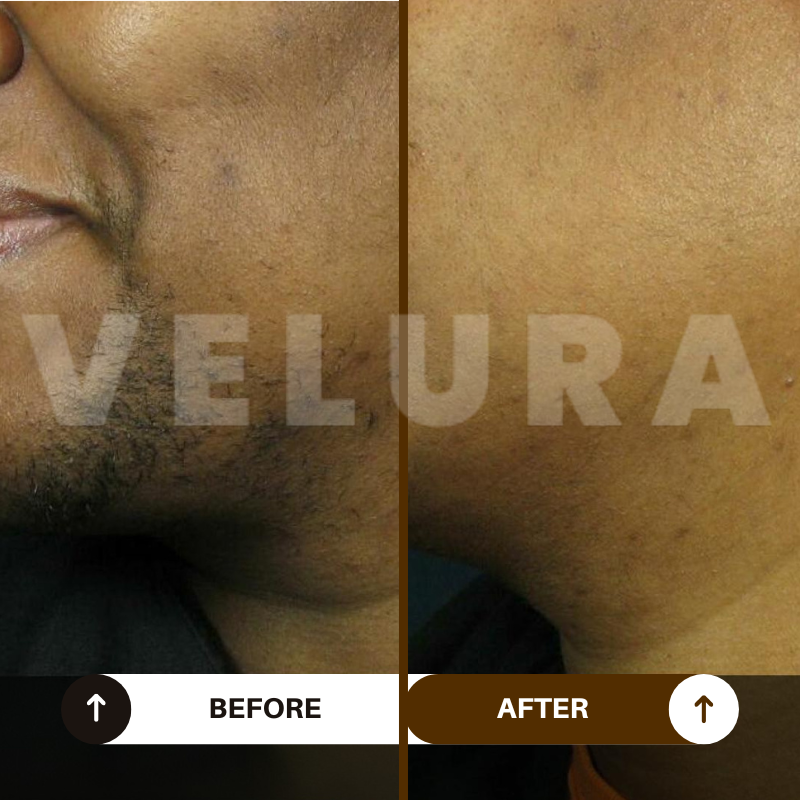 Velura® Rotundus Therapy