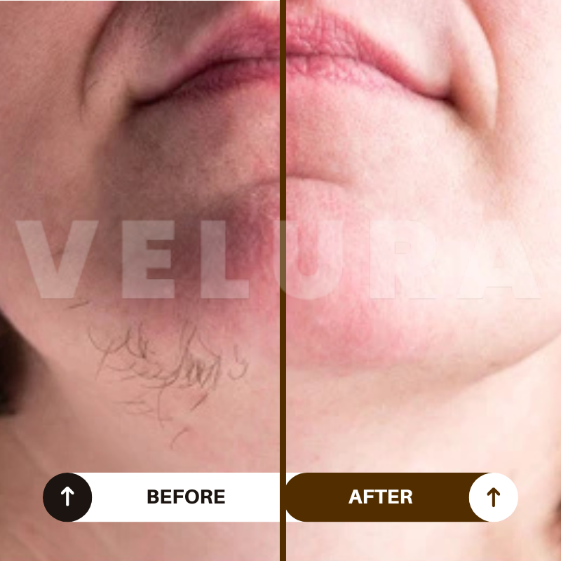 Velura® Rotundus Therapy