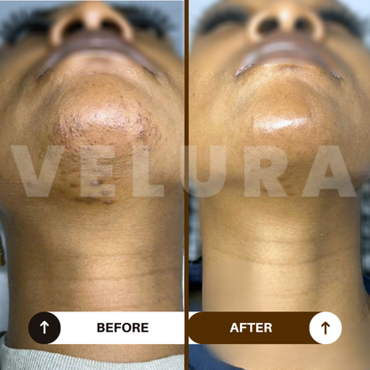 Velura® Rotundus Therapy