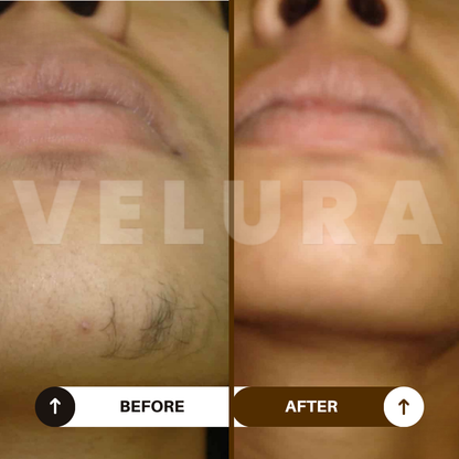Velura® Rotundus Therapy